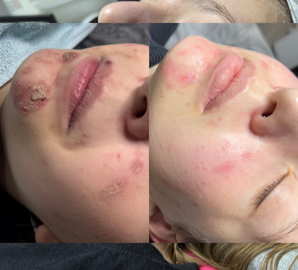 Laserové ošetrenie 3 sedenia pred a po na 9 deň