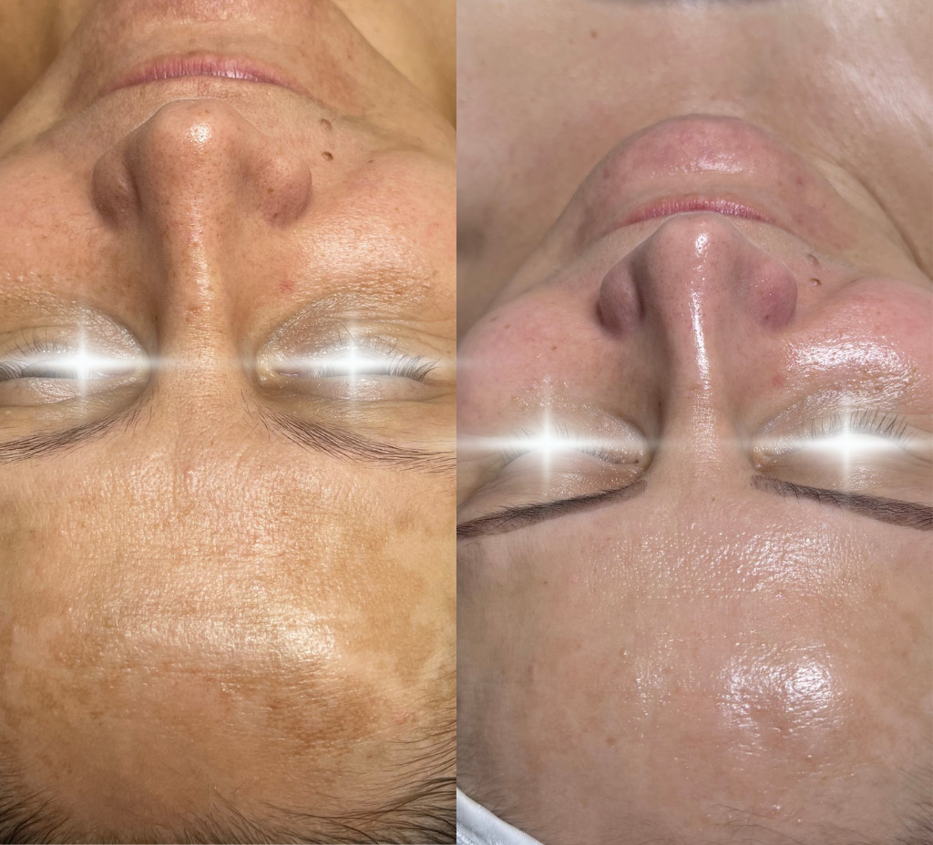Ošetrenie pleti s pigmentovými škvrnami peeling + domáca starostlivosť